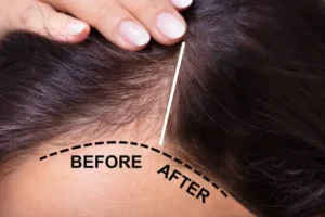 Top 5 foods to prevent hair loss?