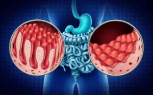 Ulcerative Colitis: Signs, Causes, and Coping Mechanisms