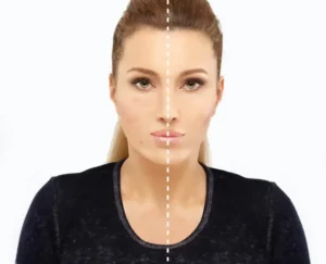 What Is Morpheus8 Treatment