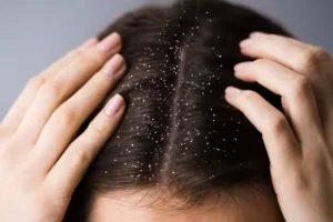What is the Best Treatment for Dry Scalp and Dandruff in 2025?