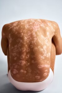 Dyshidrotic eczema treatment