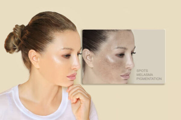 How to Choose the Best Dark Spot Corrector for Your Skin