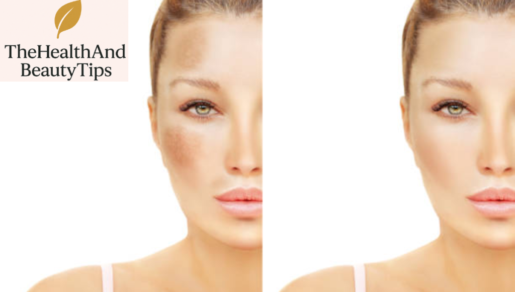Hyperpigmentation Treatment 2025: Your Complete Guide to Clear, Even-Toned Skin 3 Before & After Using Hyperpigmentation Treatments