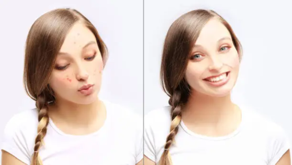 Before & After: What to Expect with Acne-Prone Skin