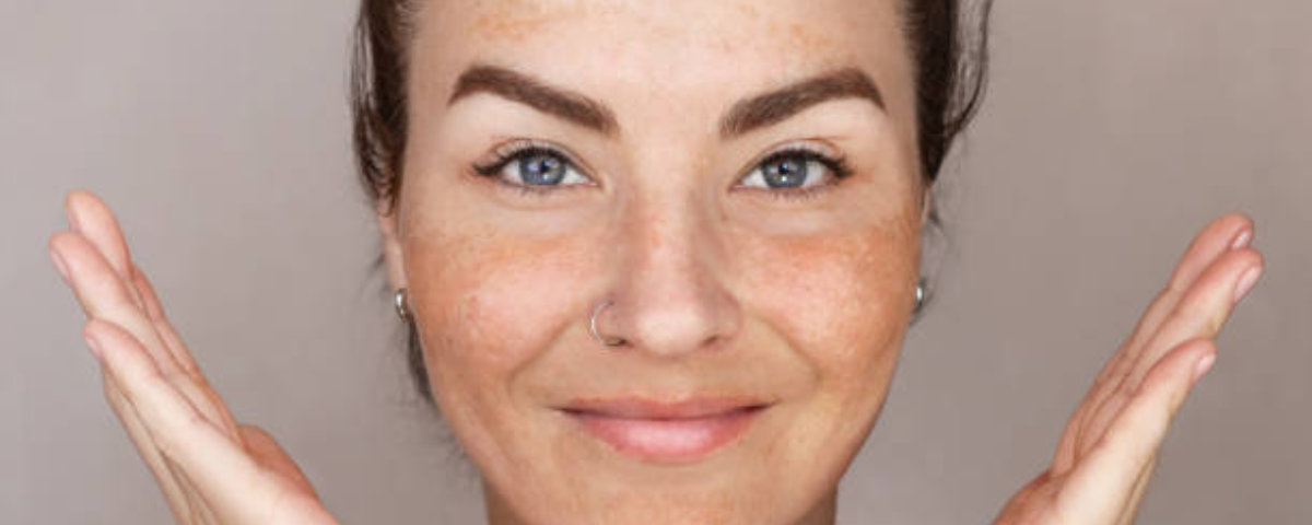 Hyperpigmentation Treatment 2025: Your Complete Guide to Clear, Even-Toned Skin