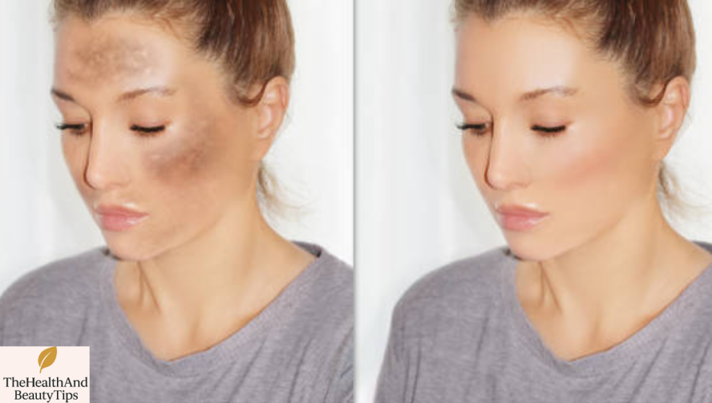 Dark Spots Removal 2025: What Actually Works for Uneven Skin Tone 3 Dark Spots Removal 2025: Before & After Using Treatments